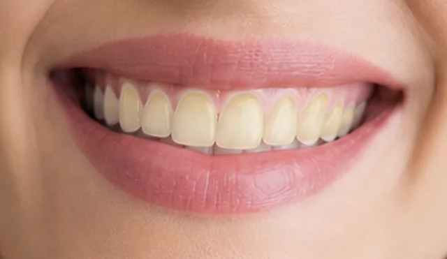 Shade simulation: teeth with a stained, yellow tone